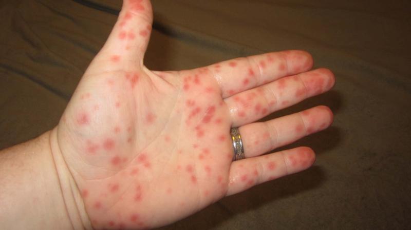 Những nốt xuất huyết hình tròn, nhỏ như vết muỗi cắn thường là ở cánh tay, cẳng chân.