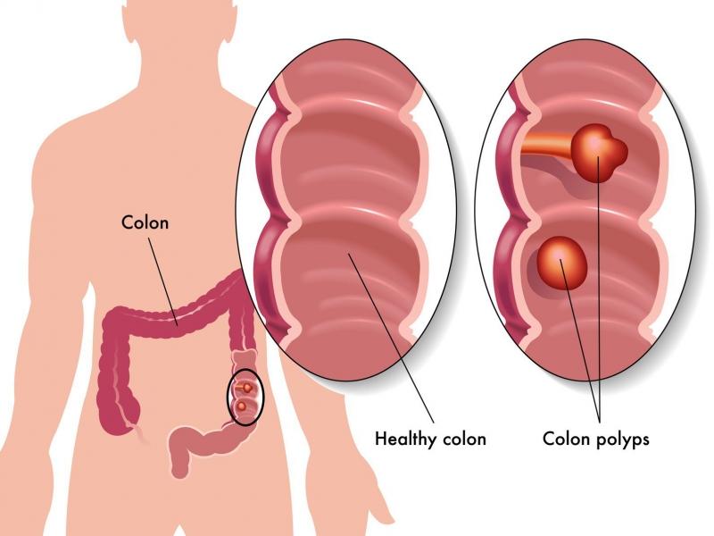 Poly tuyến đại tràng là một trong những nguyên nhân gây ung thư đại tràng