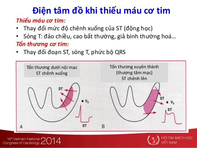 Điện tâm đồ khi thiếu máu cơ tim