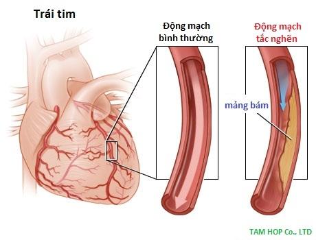 Bệnh tim mạch vành