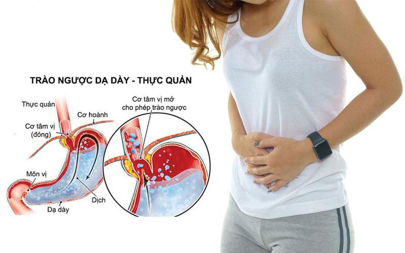 Bệnh trào ngược dạ dày - thực quản (Gerd)