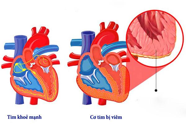 Bệnh viêm cơ tim