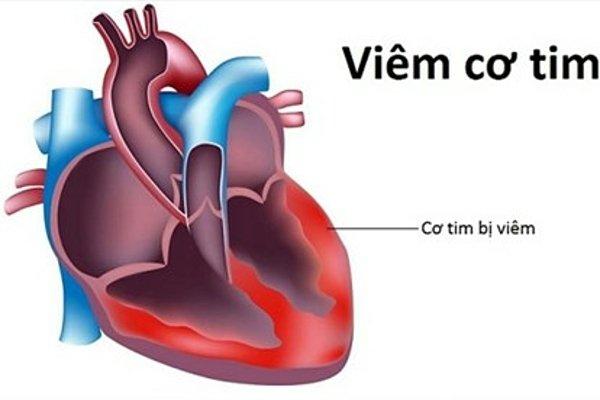 Bệnh viêm cơ tim