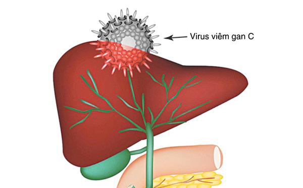 Bệnh viêm gan C là gì?