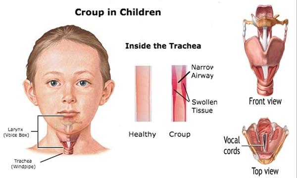 Bệnh viêm thanh, khí phế quản ở trẻ