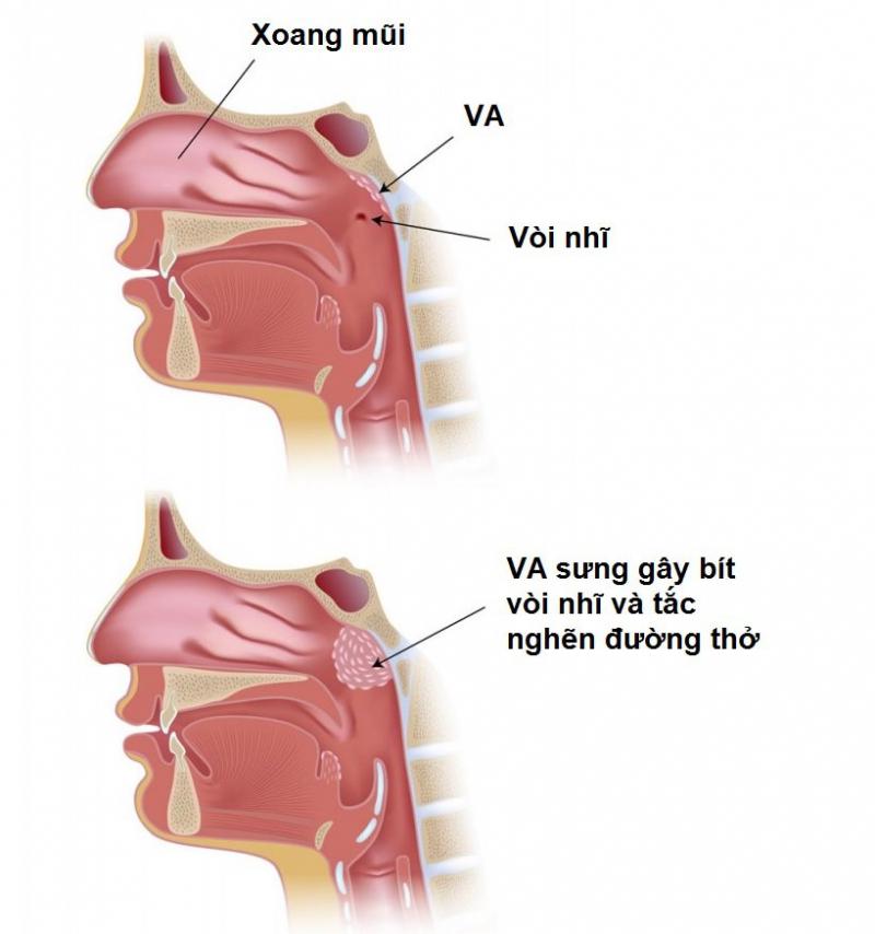 Bệnh viêm VA