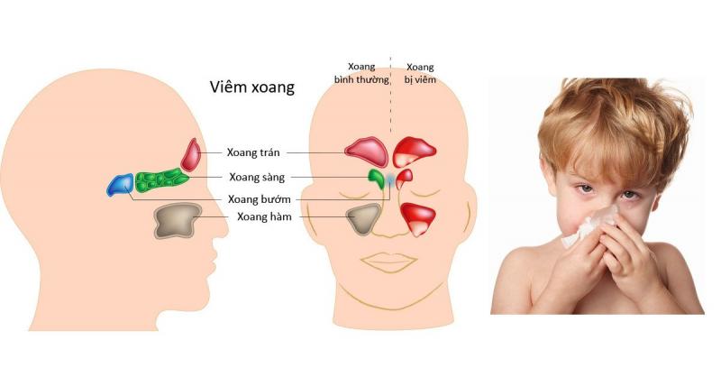 Bác sĩ Chuyên khoa II Lương Thị Xuân Hà chuyên điều trị viêm xoang
