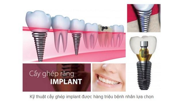 Cuanto tiempo dura el dolor de un implante dental