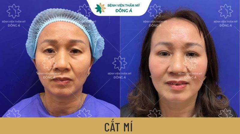 Hình ảnh khách hàng trước và sau khi cắt mí tại Bệnh viện thẩm mỹ Đông Á