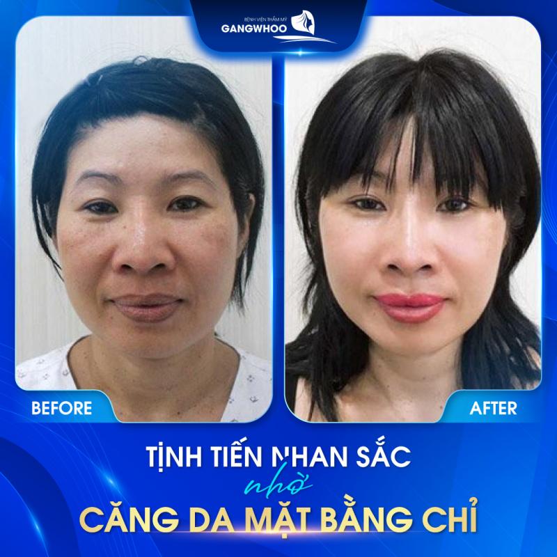 Bệnh viện thẩm mỹ Gangwhoo