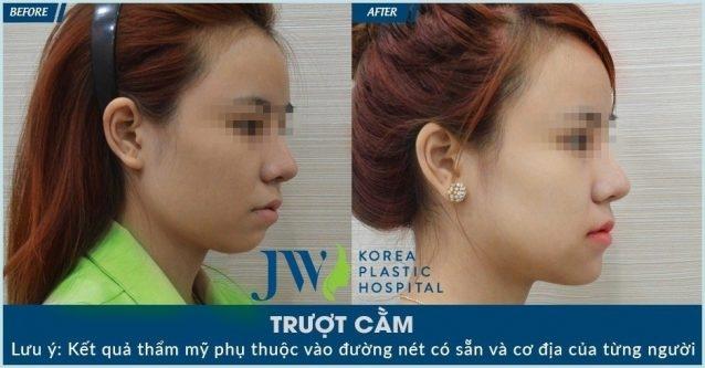 Hiệu quả trong thấy sau khi được trượt cằm tại Bệnh Viện Thẩm Mỹ JW Hàn Quốc