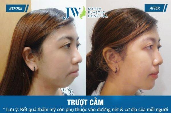 Hiệu quả trong thấy sau khi được trượt cằm tại Bệnh Viện Thẩm Mỹ JW Hàn Quốc