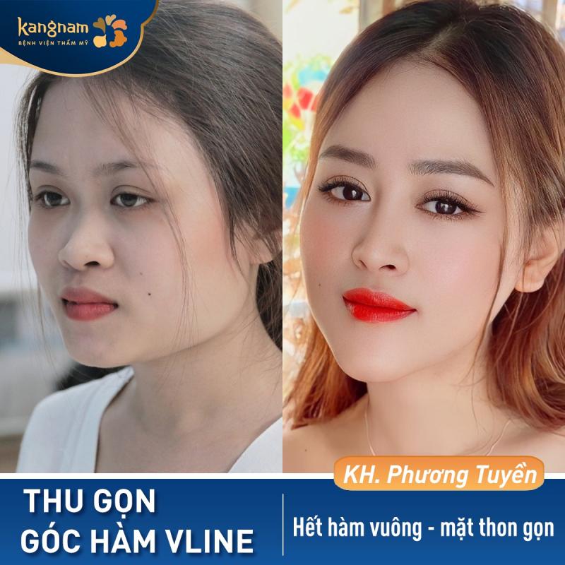 Bệnh viện thẩm mỹ Kangnam