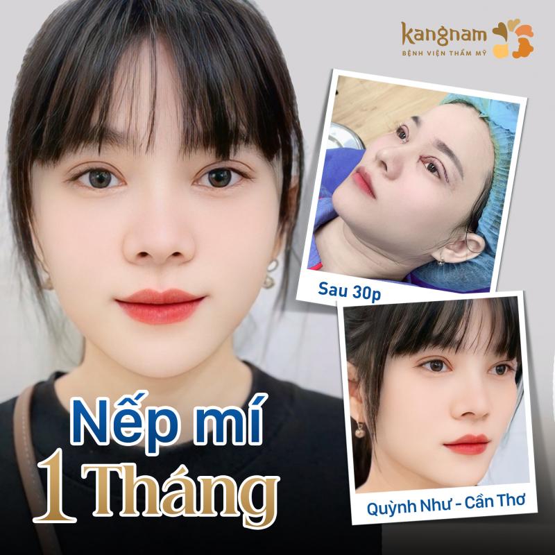 Bệnh viện thẩm mỹ Kangnam - Địa chỉ cắt mí đẹp và an toàn tại Hà Nội