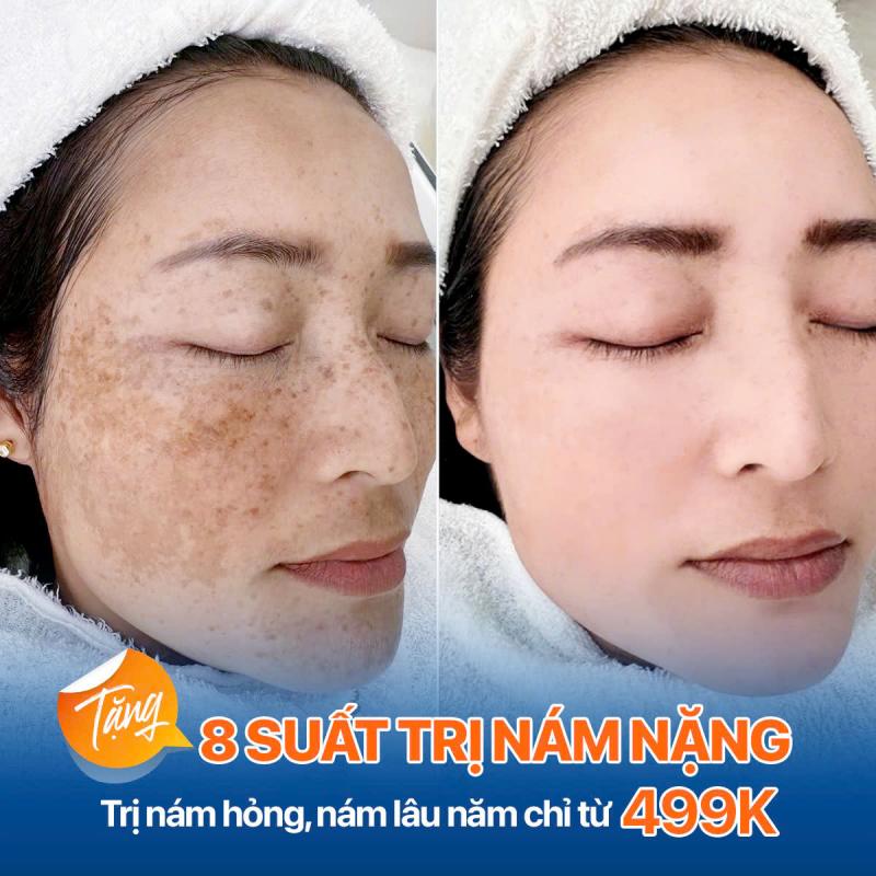 Sự thay đổi của khách hàng trước và sau trị nám