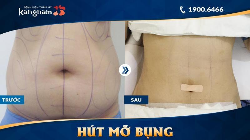 Bệnh viện thẩm mỹ Kangnam