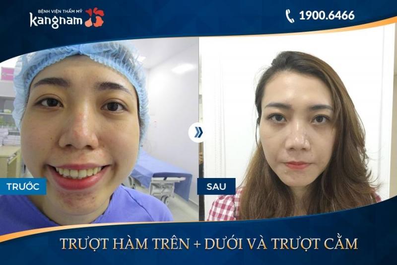 Hiệu quả trong thấy sau khi được trượt cằm tại Bệnh viện thẩm mỹ Kangnam