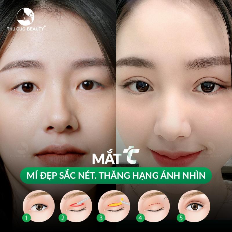 Bệnh viện đa khoa quốc tế Thu Cúc - Địa chỉ cắt mí uy tín tại Hà Nội