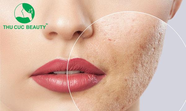 Trị mụn hiệu quả tại Thu Cúc Clinics – Chi phí hợp lý, công nghệ hiện đại