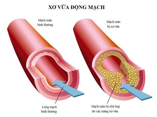 Xơ vữa động mạch là gì?