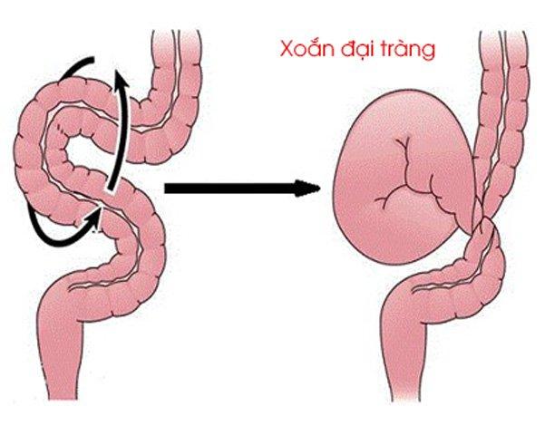 Bệnh xoắn đại tràng