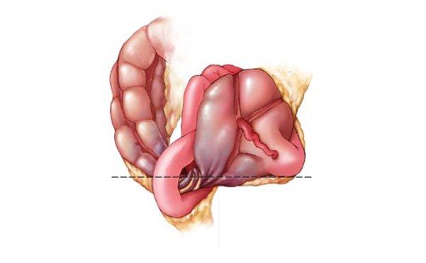 Bệnh xoắn đại tràng