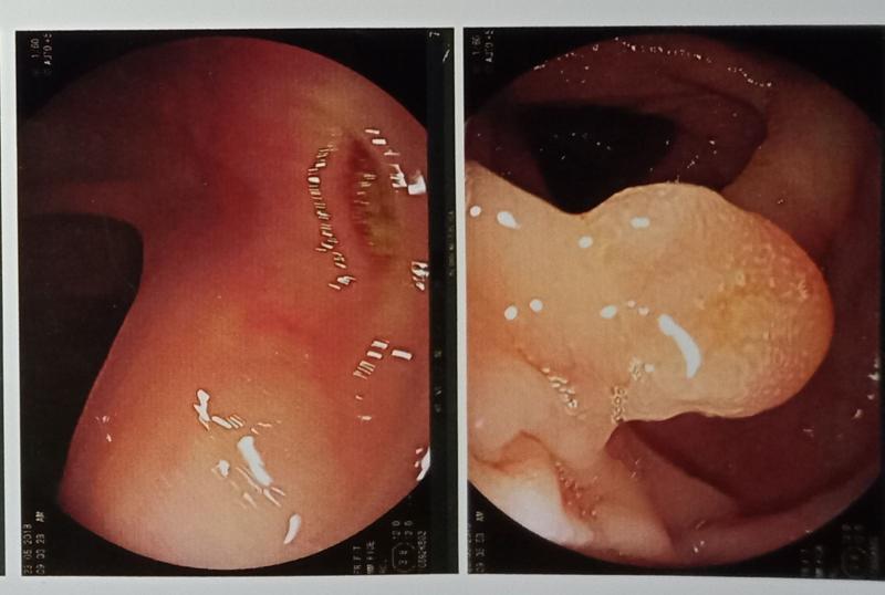 Hình ảnh polyp túi mật