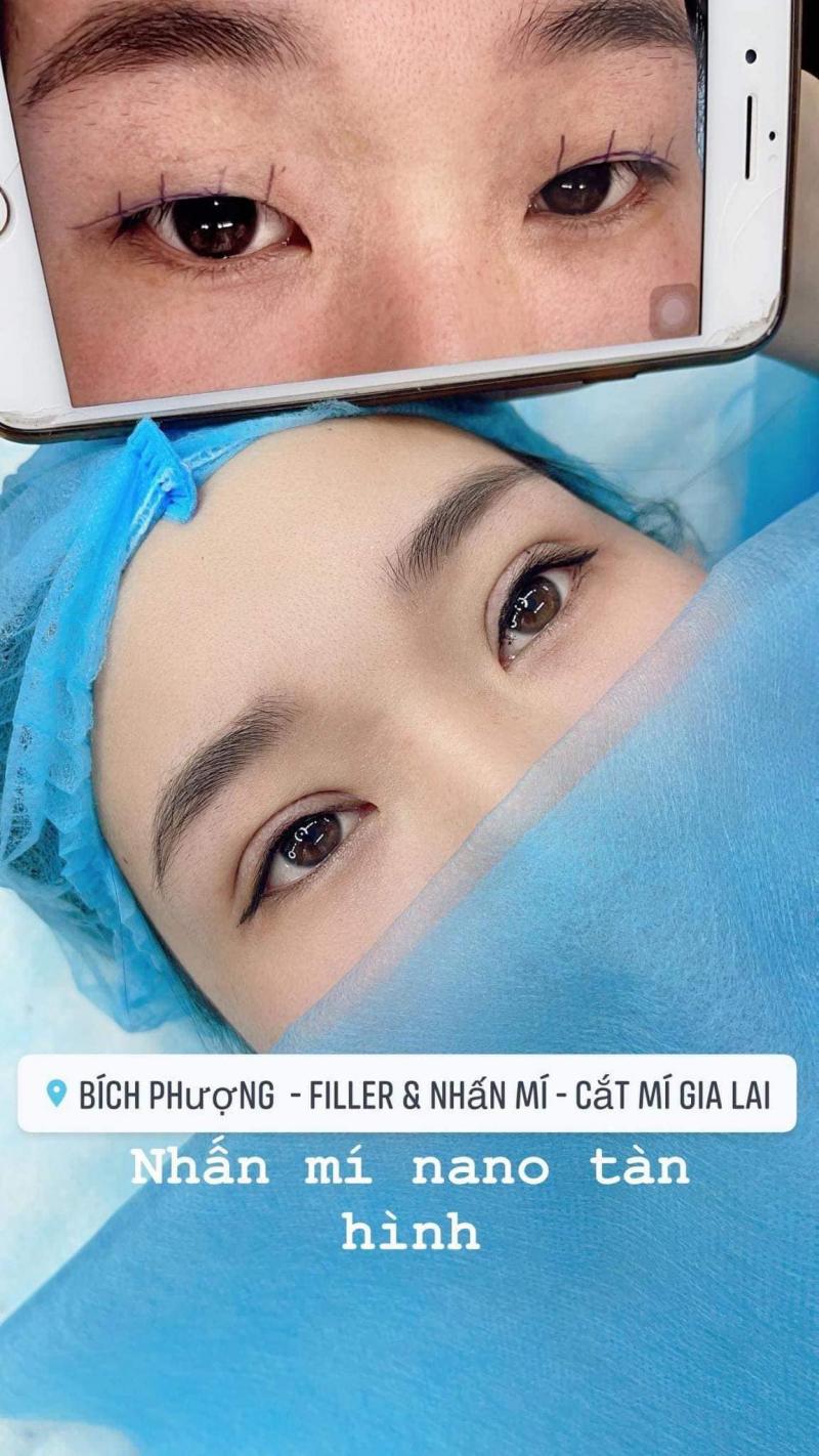 Bích Phượng - Filler & Nhấn mí - Cắt mí Gia Lai