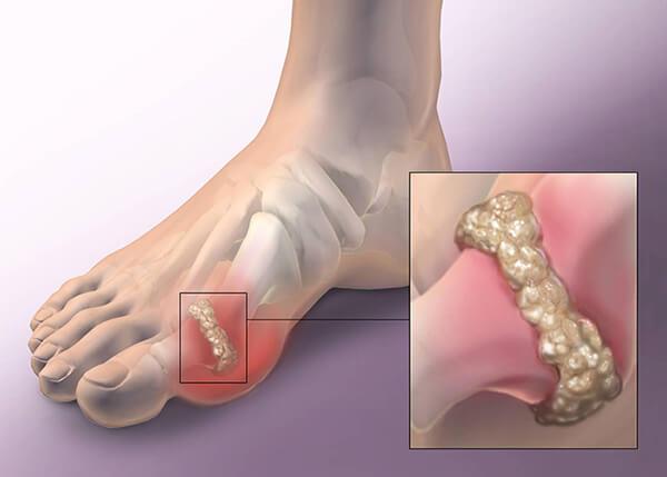 Biến chứng của bệnh gout