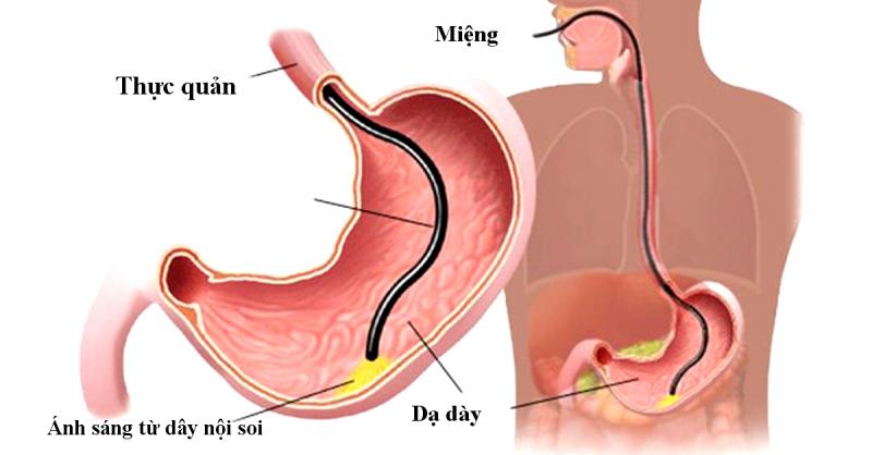 Nội soi nhiều lần có ảnh hưởng dạ dày không?