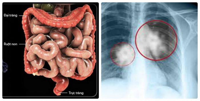 Ung thư đại tràng di căn sang phổỉ