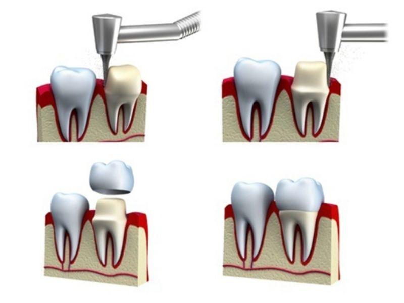 Bọc răng sứ chắc chắn phải 