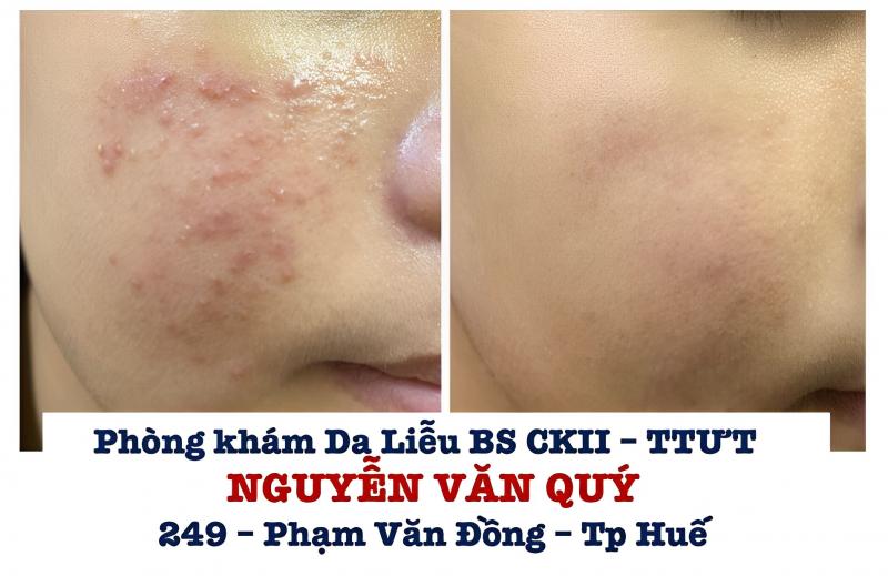 Phòng khám da liễu - Bác sĩ chuyên khoa II Nguyễn Văn Quý