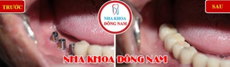 Trồng ba răng Implant hàm dưới