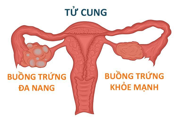 Buồng trứng đa nang là gì?