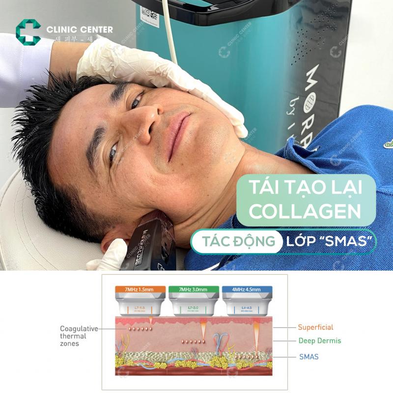 C Spa & Clinic - Trị Sẹo Rỗ