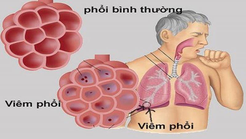 Các bệnh về phổi có thể gây nguy hiểm tới tính mạng con người