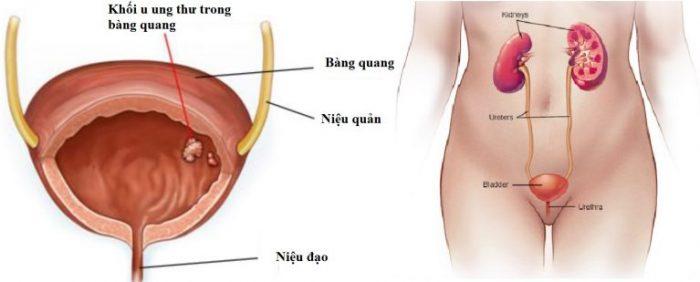 Nếu được chẩn đoán sớm và điều trị kịp thời thì tỷ lệ sống sau 5 năm của ung thư bàng quang có thể lên tới 80%.