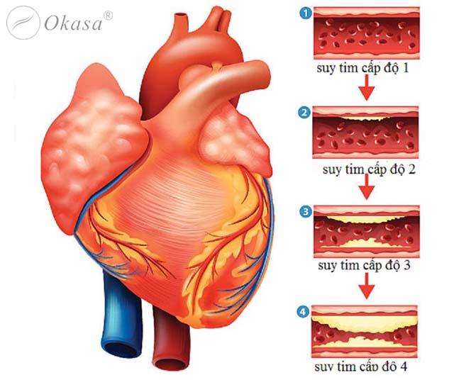 Các cấp độ suy tim