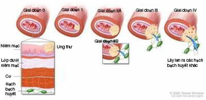 Các giai đoạn bệnh ung thư máu