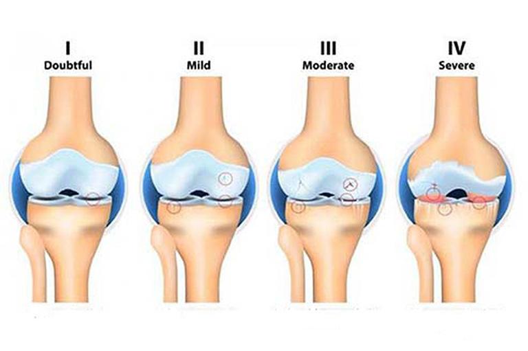 Các giai đoạn của viêm khớp dạng thấp