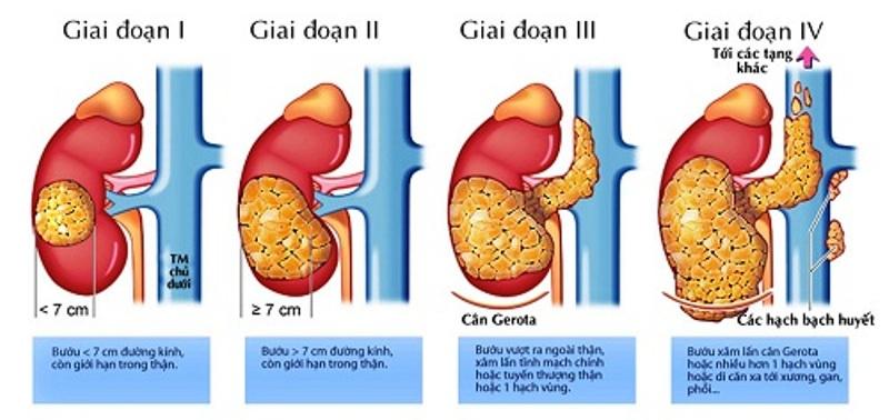 ung thư gan gồm 4 giai đoạn