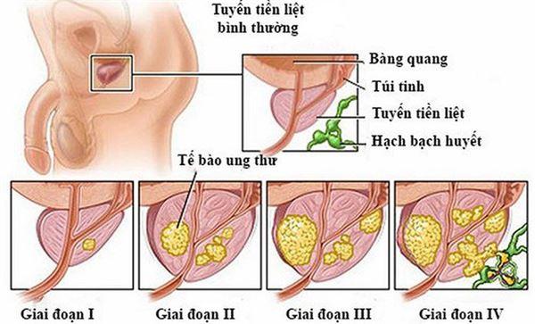 Các giai đoạn của ung thư tuyến tiền liệt.