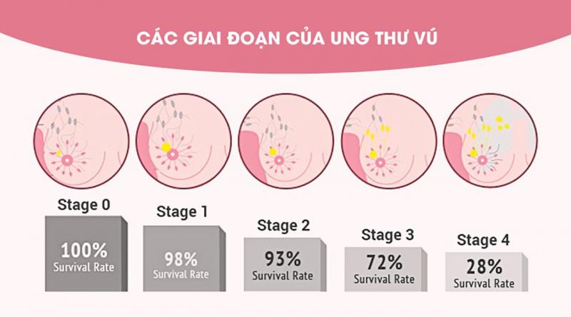 Các giai đoạn phát triển của ung thư vú