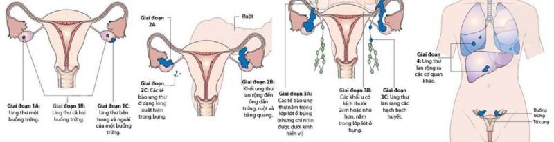 Các giai đoạn phát triển ung thư buồng trứng