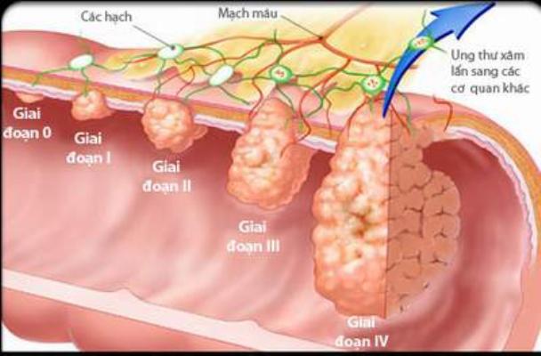 Các giai đoạn ung thư dạ dày