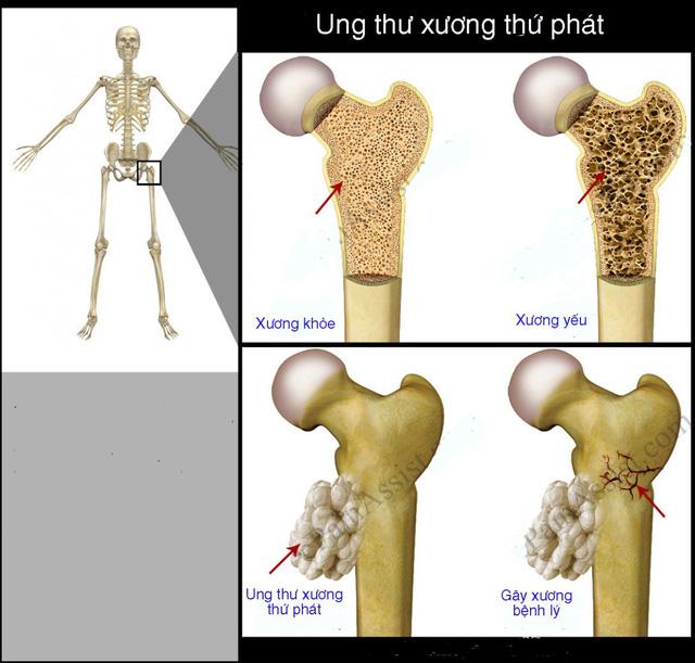 ung thư xương