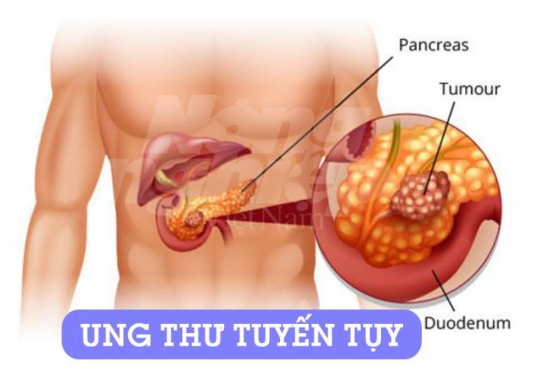 Siêu âm tuyến tụy