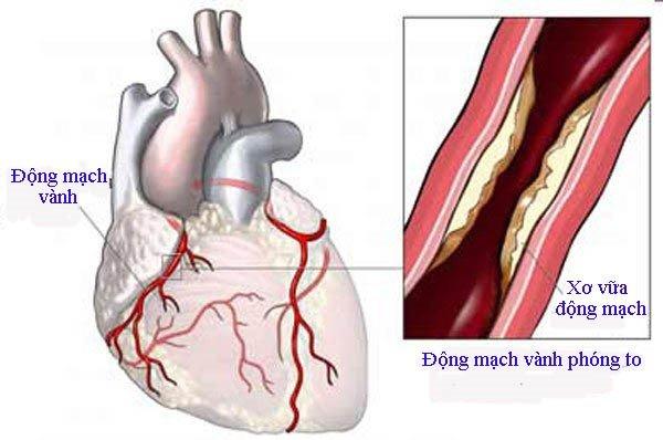 Bệnh mạch vành do mảng xơ vữa