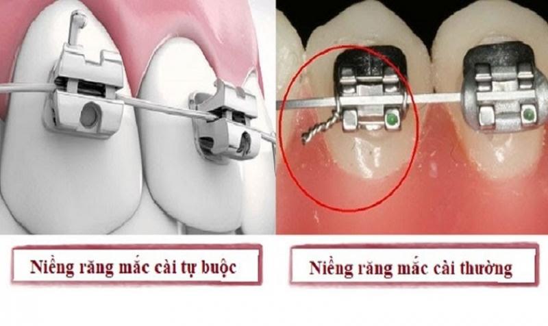 Phân loại niềng răng mắc cài kim loại